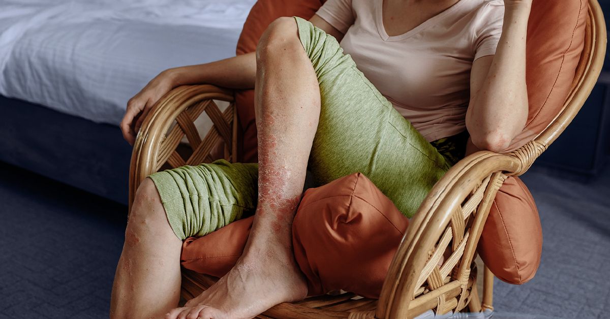 What to know about Koebner phenomenon and psoriasis