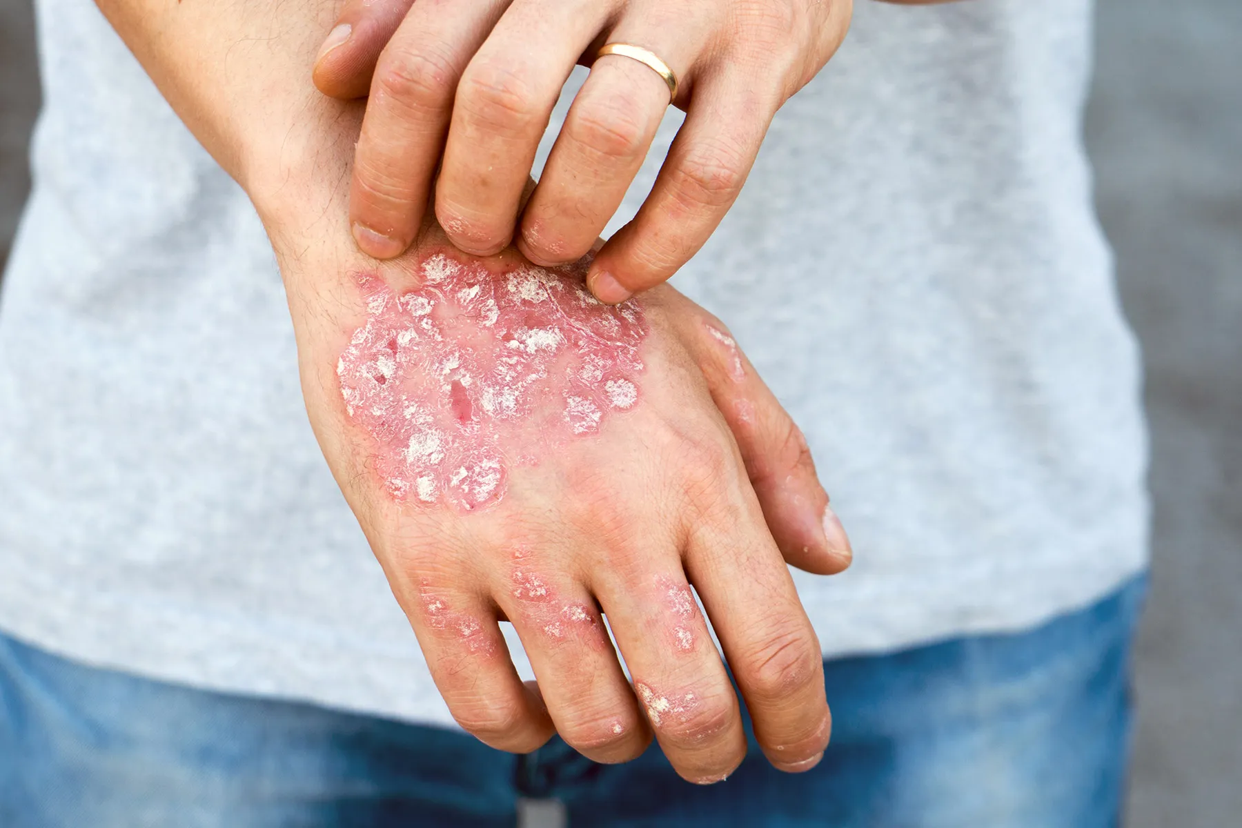 Types of Psoriasis: Symptoms, Triggers, & Treatments
