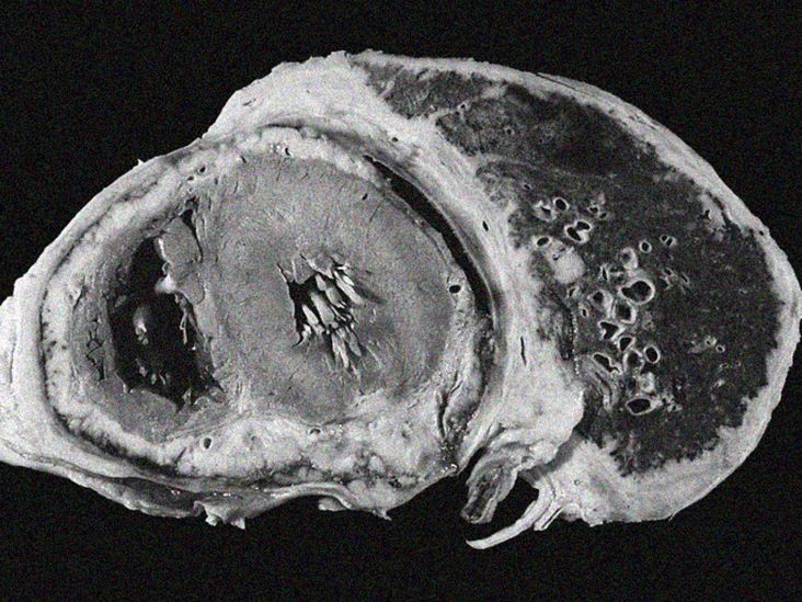 ImÃ¡genes del cÃ¡ncer de pulmÃ³n, radiografÃ­as y mÃ¡s
